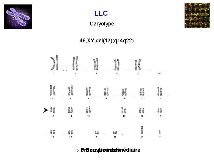 LLC Caryotype 46, XY, del(13)(q 14 q 22) 47, XX, +12 ÞÞ Pronostic Bon