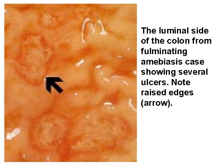 The luminal side of the colon from fulminating amebiasis case showing several ulcers. Note