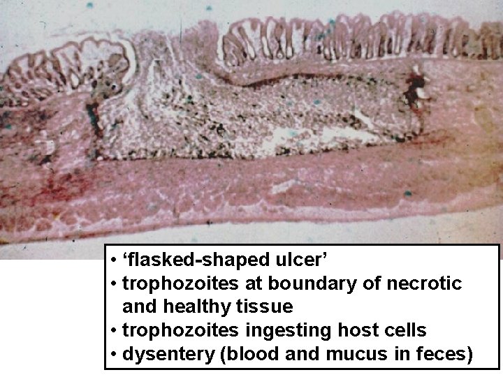  • ‘flasked-shaped ulcer’ • trophozoites at boundary of necrotic and healthy tissue •