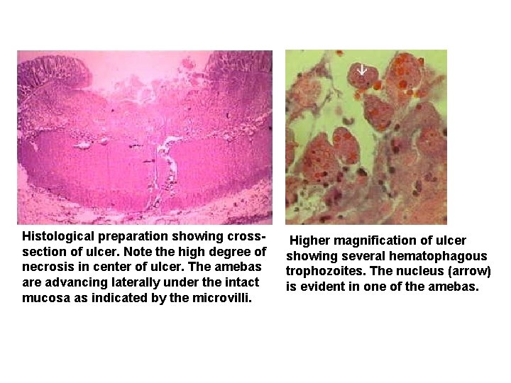 Histological preparation showing crosssection of ulcer. Note the high degree of necrosis in center