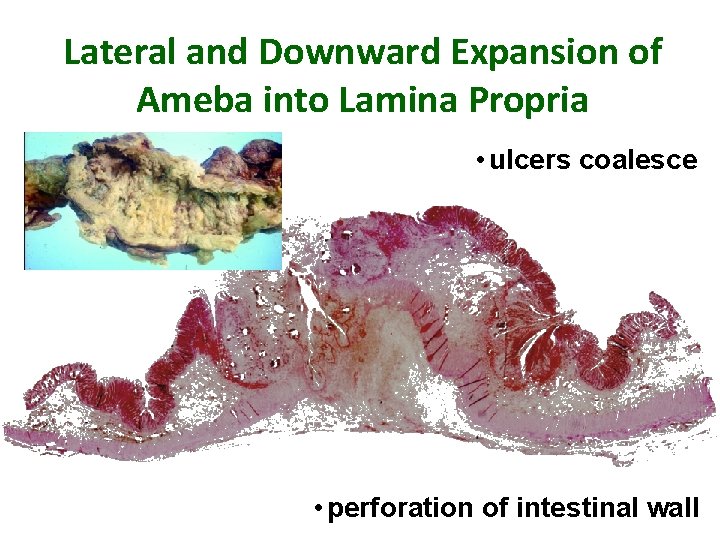 Lateral and Downward Expansion of Ameba into Lamina Propria • ulcers coalesce • perforation