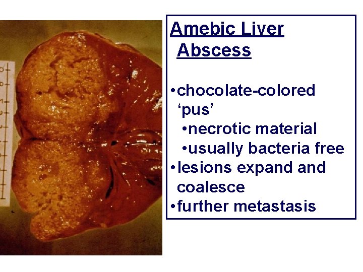 Amebic Liver Abscess • chocolate-colored ‘pus’ • necrotic material • usually bacteria free •