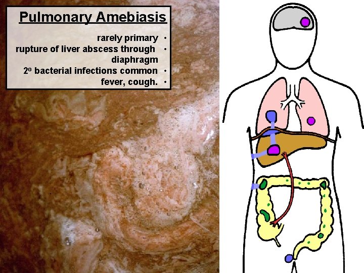 Pulmonary Amebiasis rarely primary rupture of liver abscess through diaphragm 2 o bacterial infections