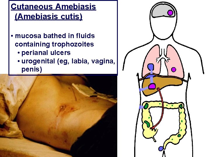 Cutaneous Amebiasis (Amebiasis cutis) • mucosa bathed in fluids containing trophozoites • perianal ulcers