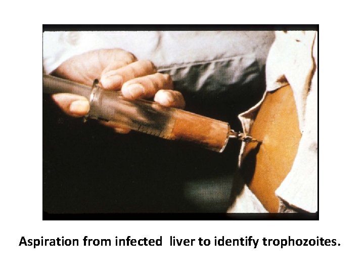 Aspiration from infected liver to identify trophozoites. 