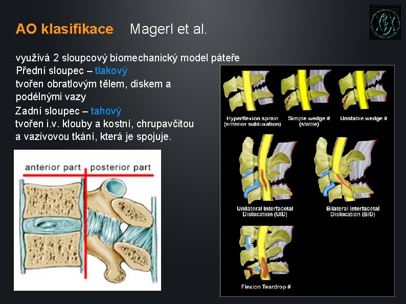 AO klasifikace Magerl et al. využívá 2 sloupcový biomechanický model páteře Přední sloupec –