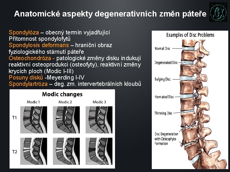 Anatomické aspekty degenerativních změn páteře Spondylóza – obecný termín vyjadřující Přítomnost spondylofytů Spondylosis deformans