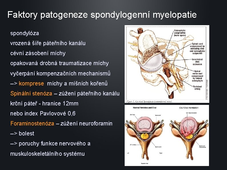 Faktory patogeneze spondylogenní myelopatie spondylóza vrozená šíře páteřního kanálu cévní zásobení míchy opakovaná drobná