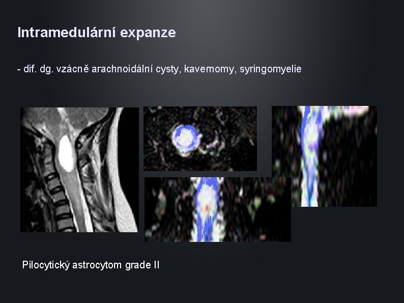 Intramedulární expanze - dif. dg. vzácně arachnoidální cysty, kavernomy, syringomyelie Pilocytický astrocytom grade II