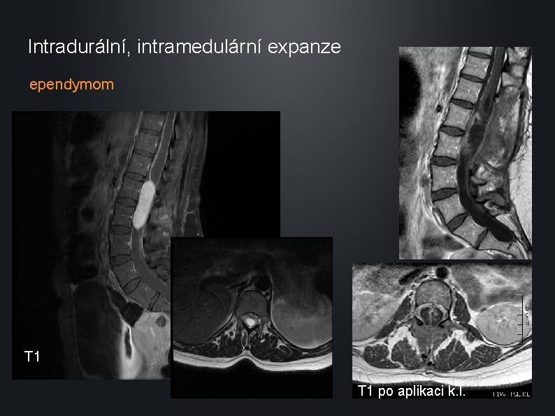 Intradurální, intramedulární expanze ependymom T 1 po aplikaci k. l. 