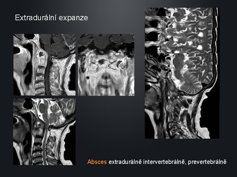 Extradurální expanze Absces extradurálně intervertebrálně, prevertebrálně 