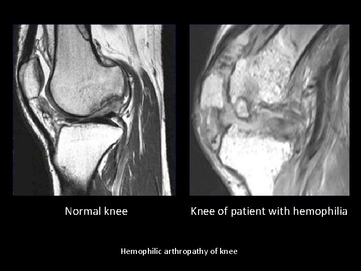 Normal knee Knee of patient with hemophilia Hemophilic arthropathy of knee 