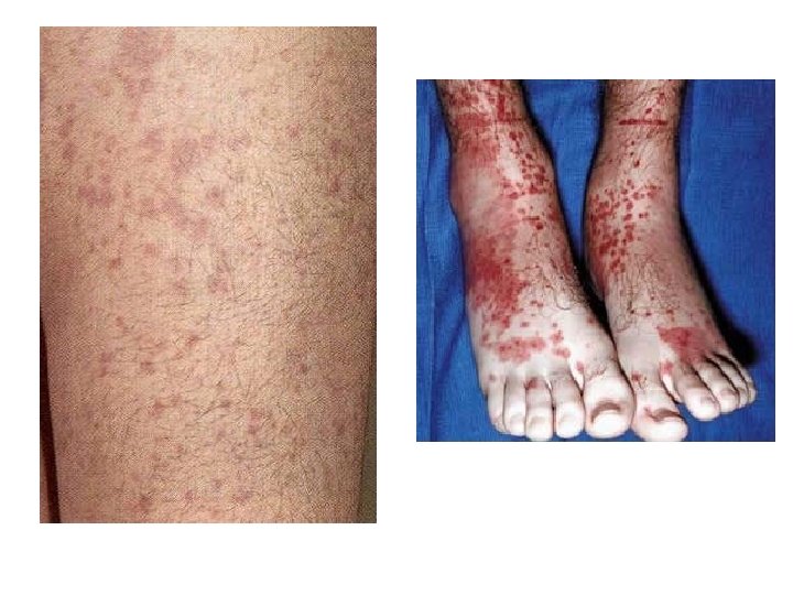 Petechiae 