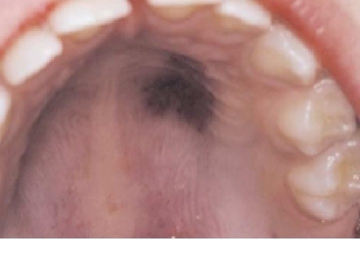 Palatal ecchymosis 