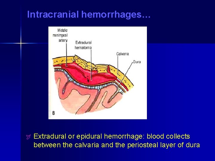 Intracranial hemorrhages… ÿ Extradural or epidural hemorrhage: blood collects between the calvaria and the Intracranial hemorrhages… ÿ Extradural or epidural hemorrhage: blood collects between the calvaria and the