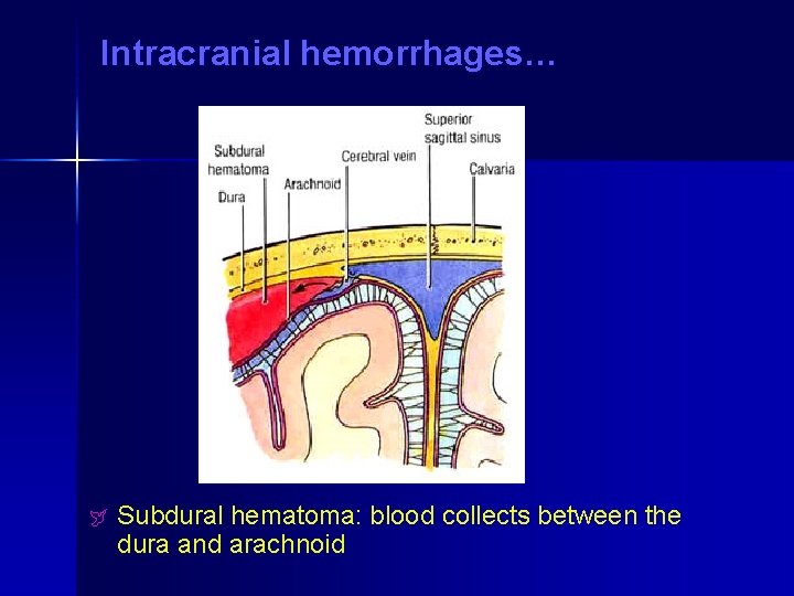 Intracranial hemorrhages… ÿ Subdural hematoma: blood collects between the dura and arachnoid Intracranial hemorrhages… ÿ Subdural hematoma: blood collects between the dura and arachnoid