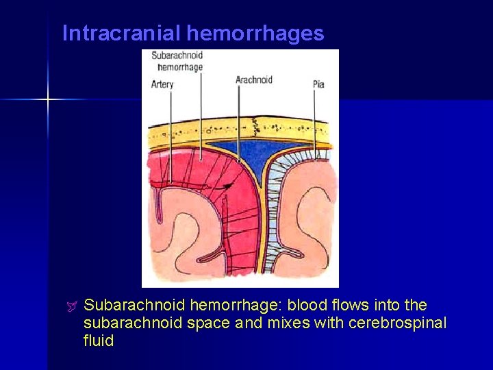 Intracranial hemorrhages ÿ Subarachnoid hemorrhage: blood flows into the subarachnoid space and mixes with Intracranial hemorrhages ÿ Subarachnoid hemorrhage: blood flows into the subarachnoid space and mixes with