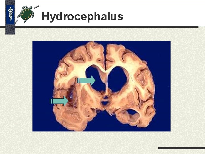 Hydrocephalus Hydrocephalus
