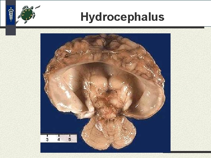 Hydrocephalus Hydrocephalus