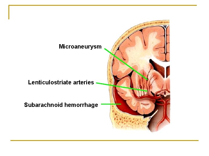 Microaneurysm Lenticulostriate arteries Subarachnoid hemorrhage Microaneurysm Lenticulostriate arteries Subarachnoid hemorrhage