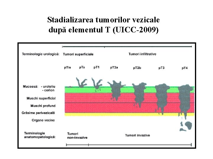 Stadializarea tumorilor vezicale după elementul T (UICC-2009) 