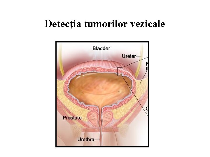 Detecţia tumorilor vezicale 