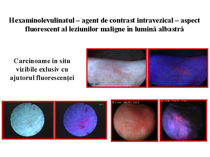 Hexaminolevulinatul – agent de contrast intravezical – aspect fluorescent al leziunilor maligne în lumină