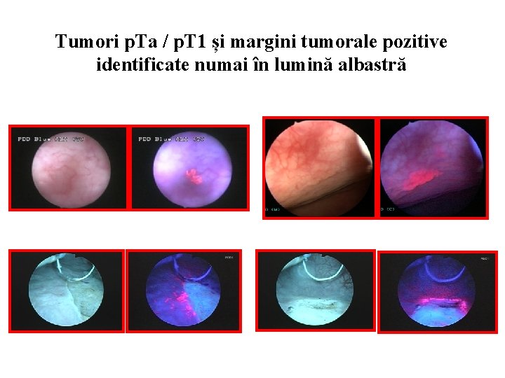 Tumori p. Ta / p. T 1 și margini tumorale pozitive identificate numai în