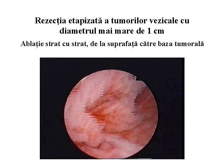 Rezecţia etapizată a tumorilor vezicale cu diametrul mai mare de 1 cm Ablație strat
