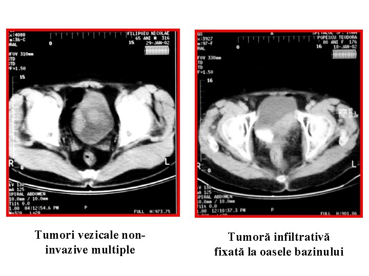 Tumori vezicale noninvazive multiple Tumoră infiltrativă fixată la oasele bazinului 