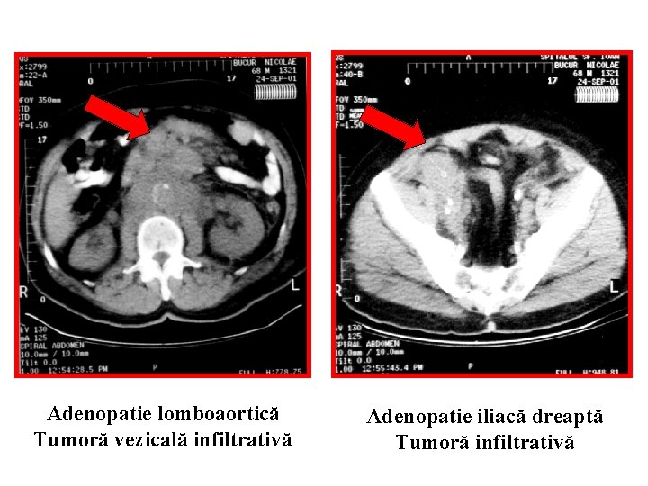 Adenopatie lomboaortică Tumoră vezicală infiltrativă Adenopatie iliacă dreaptă Tumoră infiltrativă 