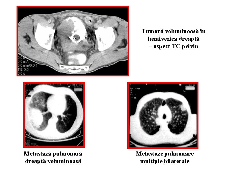 Tumoră voluminoasă în hemivezica dreaptă – aspect TC pelvin Metastază pulmonară dreaptă voluminoasă Metastaze