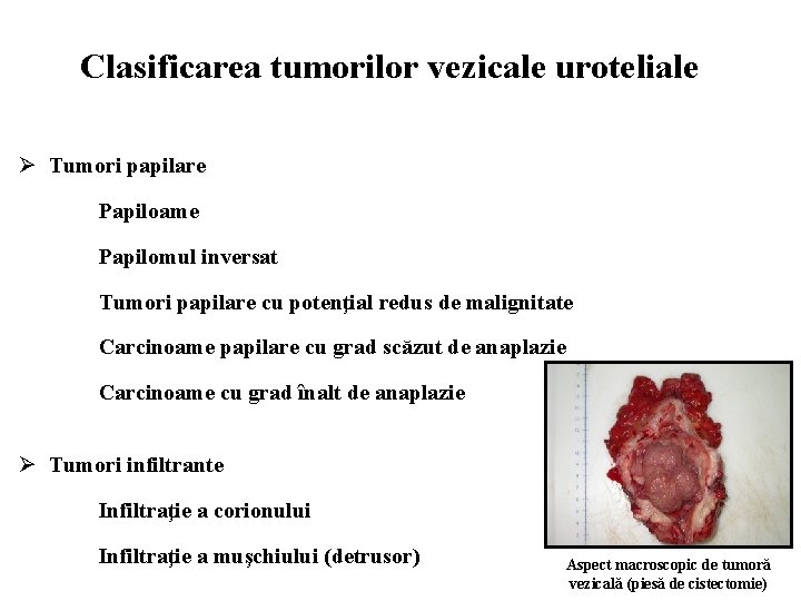 Clasificarea tumorilor vezicale uroteliale Ø Tumori papilare Papiloame Papilomul inversat Tumori papilare cu potenţial