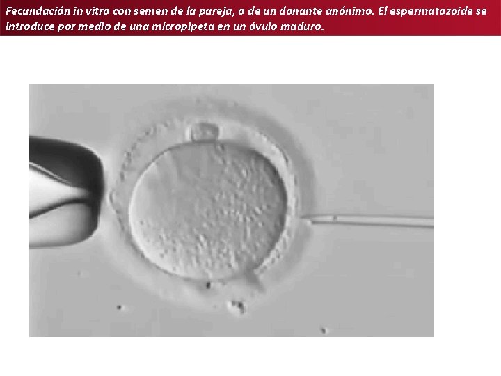 Fecundación in vitro con semen de la pareja, o de un donante anónimo. El