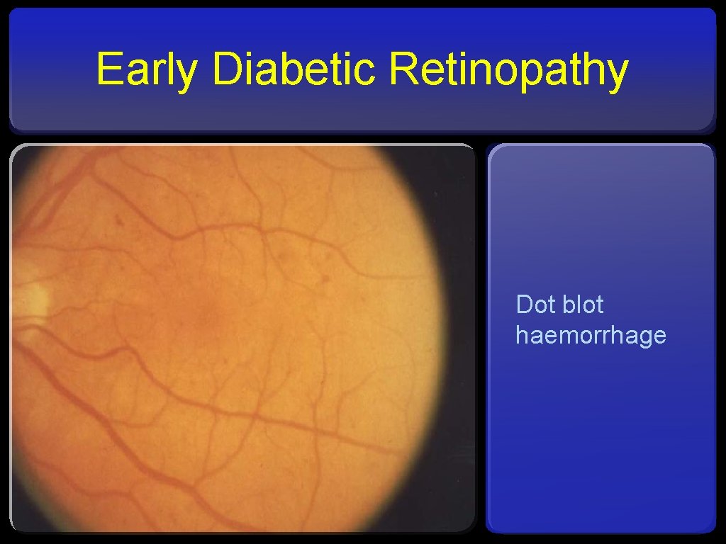 Early Diabetic Retinopathy Dot blot haemorrhage 