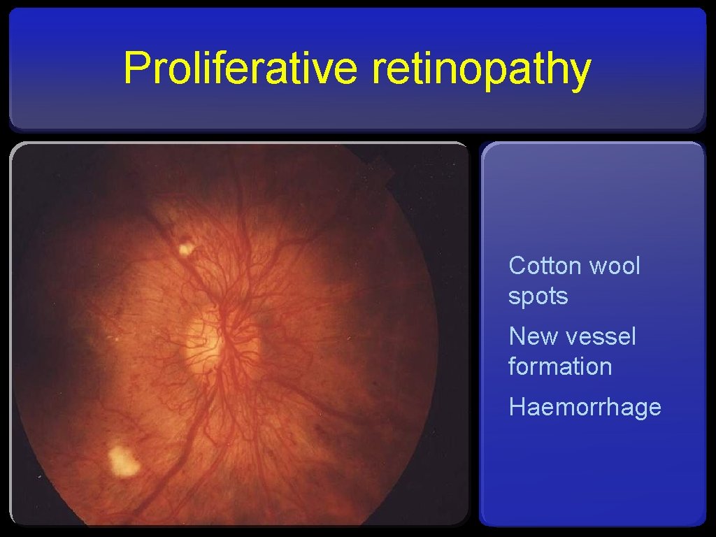 Proliferative retinopathy Cotton wool spots New vessel formation Haemorrhage 