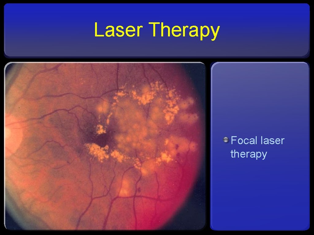 Laser Therapy Focal laser therapy 