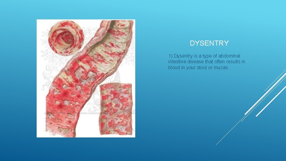 DYSENTRY 1) Dysentry is a type of abdominal intestine disease that often results in