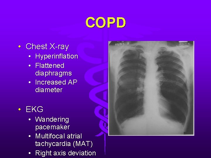 COPD • Chest X-ray • Hyperinflation • Flattened diaphragms • Increased AP diameter • COPD • Chest X-ray • Hyperinflation • Flattened diaphragms • Increased AP diameter •