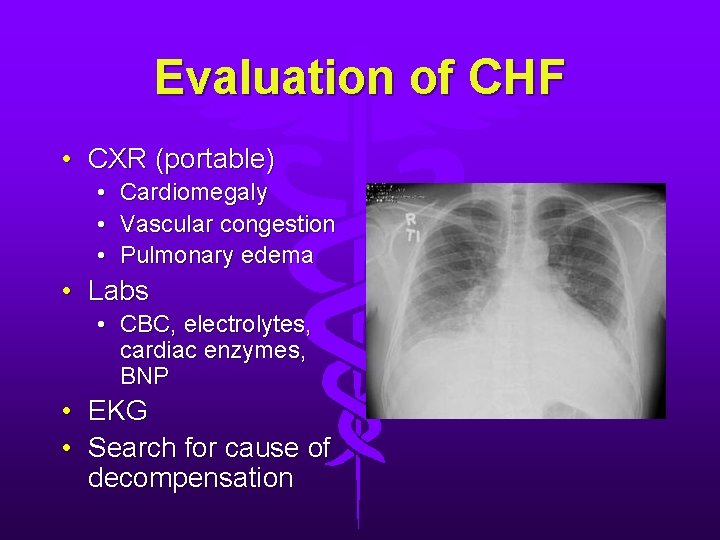 Evaluation of CHF • CXR (portable) • • • Cardiomegaly Vascular congestion Pulmonary edema Evaluation of CHF • CXR (portable) • • • Cardiomegaly Vascular congestion Pulmonary edema