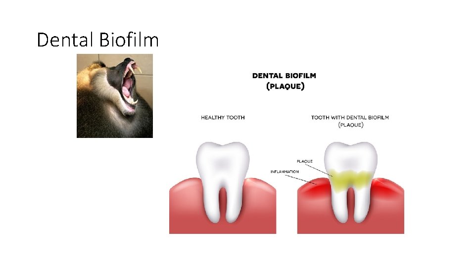 Dental Biofilm 