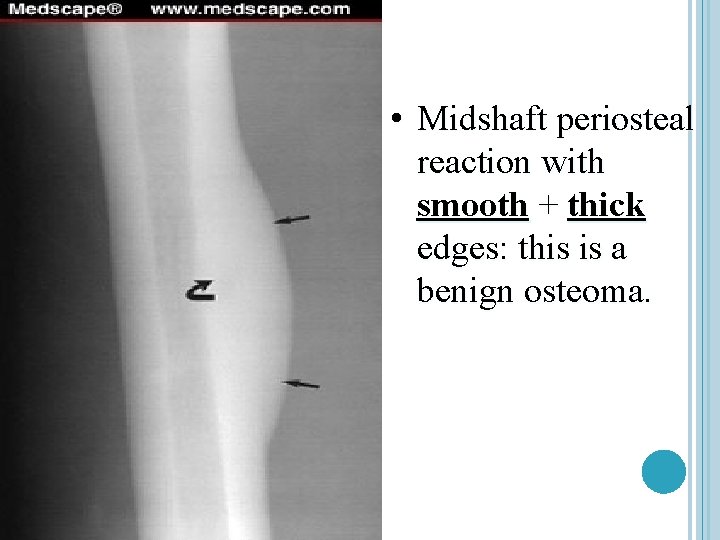  • Midshaft periosteal reaction with smooth + thick edges: this is a benign