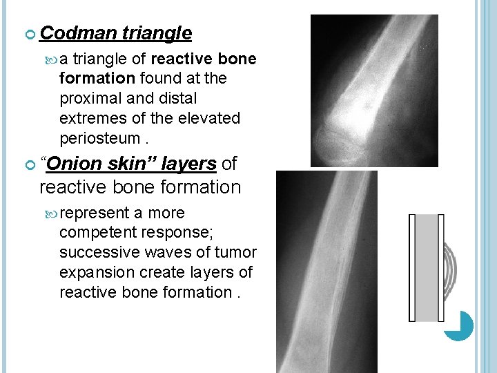  Codman triangle a triangle of reactive bone formation found at the proximal and