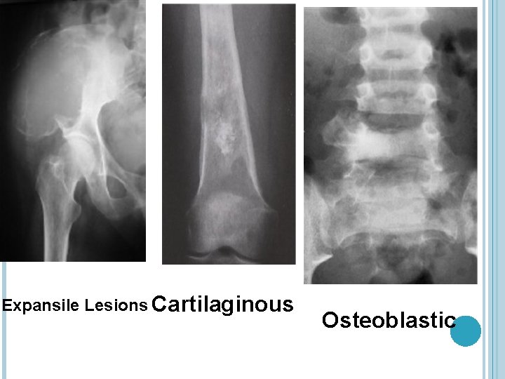 Expansile Lesions Cartilaginous Osteoblastic 