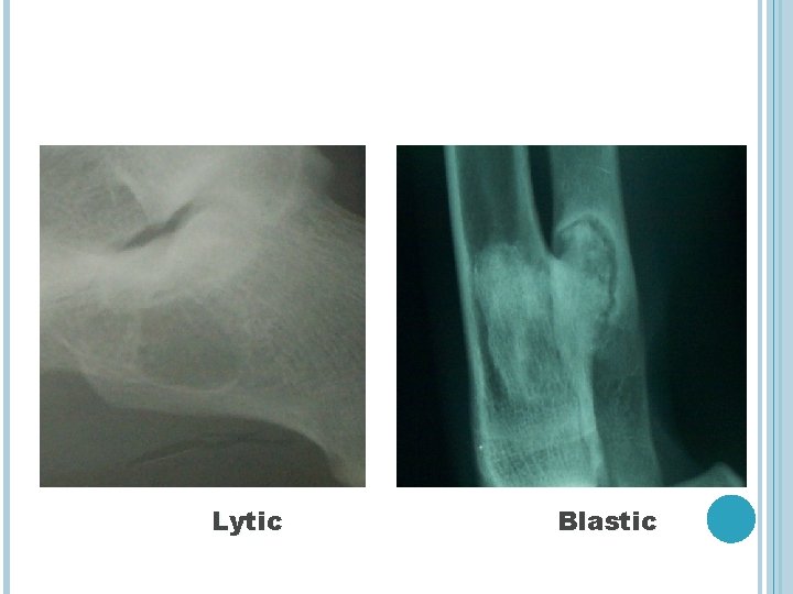 Lytic Blastic 