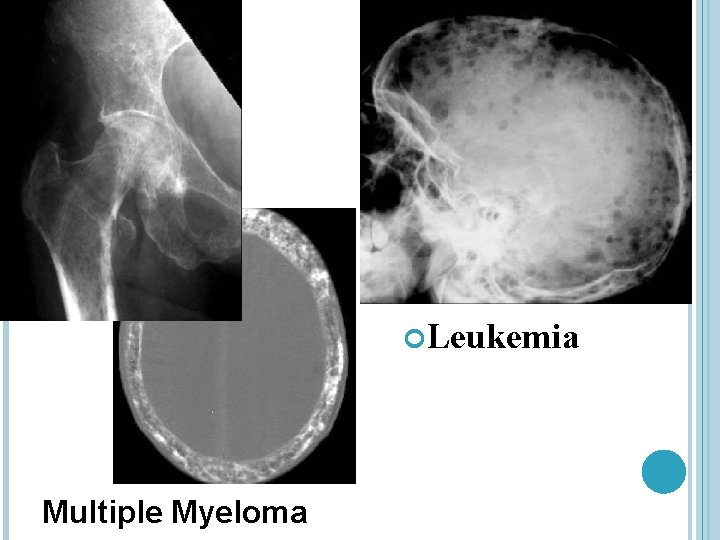  Leukemia Multiple Myeloma 