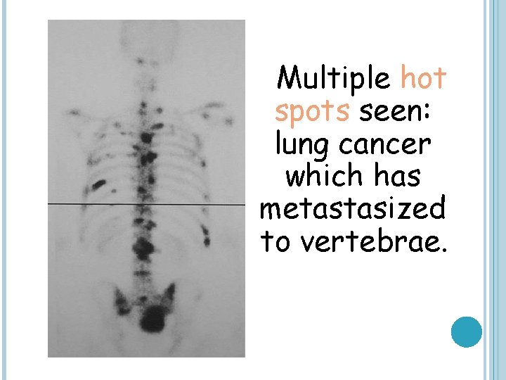 Multiple hot spots seen: lung cancer which has metastasized to vertebrae. 