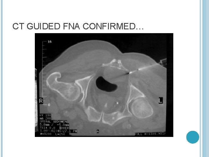 CT GUIDED FNA CONFIRMED… 