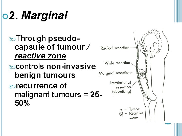  2. Marginal Through pseudocapsule of tumour / reactive zone controls non-invasive benign tumours