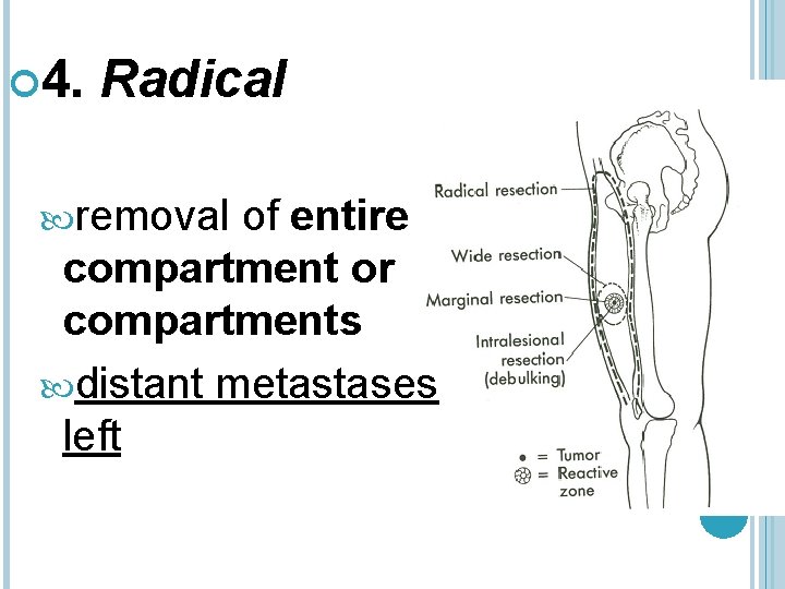  4. Radical removal of entire compartment or compartments distant metastases left 